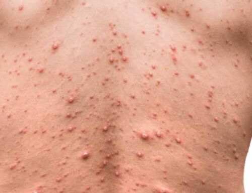 Salud confirma el tercer caso de mpox: se trata de un vecino de Heredia